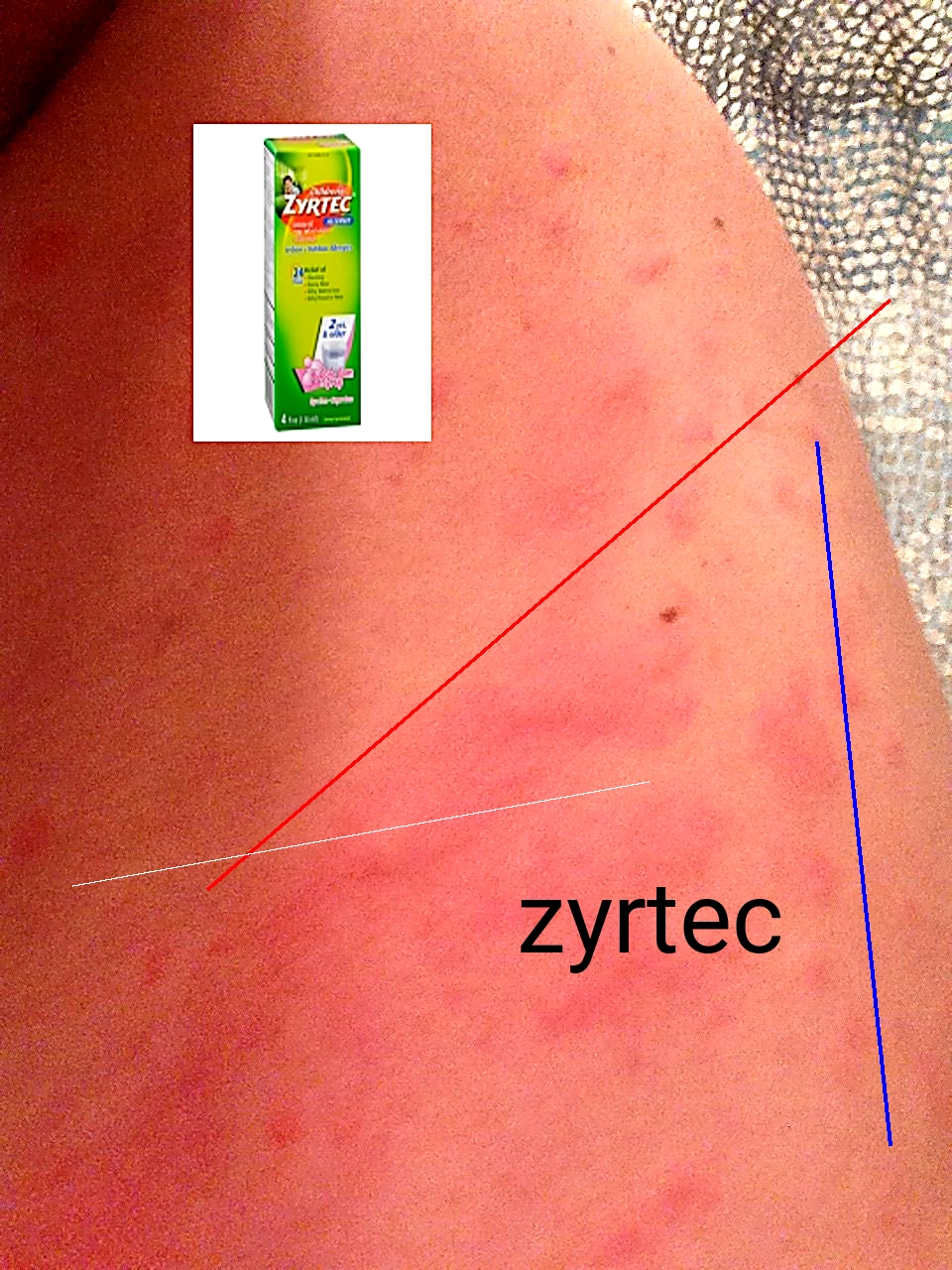 Zyrtec sur ordonnance